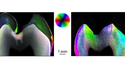 Nanoforscher untersuchen Karies