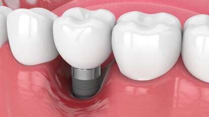 New research: understanding periodontal & peri-implant soft tissues better