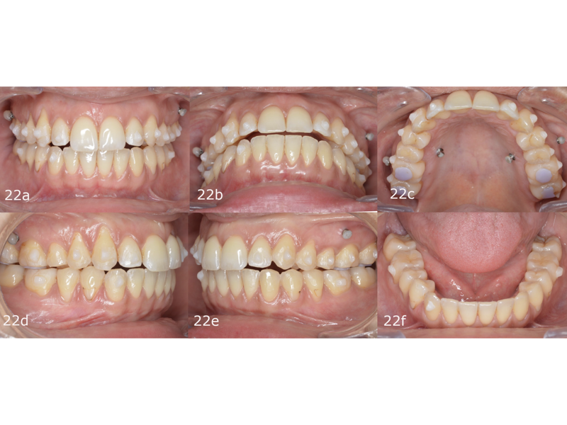 Figs. 22a–f: Situation at the start of the second phase of aligner treatment.