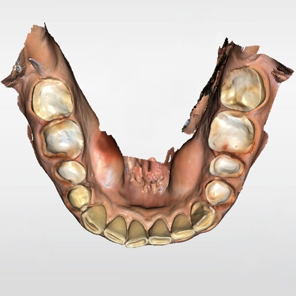 Fig. 7b: Digital scan of the prepared mandibular teeth.