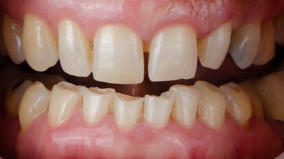 Early diagnosis is key: GC Dental Campus webinar to discuss direct restorations for tooth wear