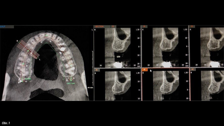 Před zákrokem byl pořízen CBCT sken.