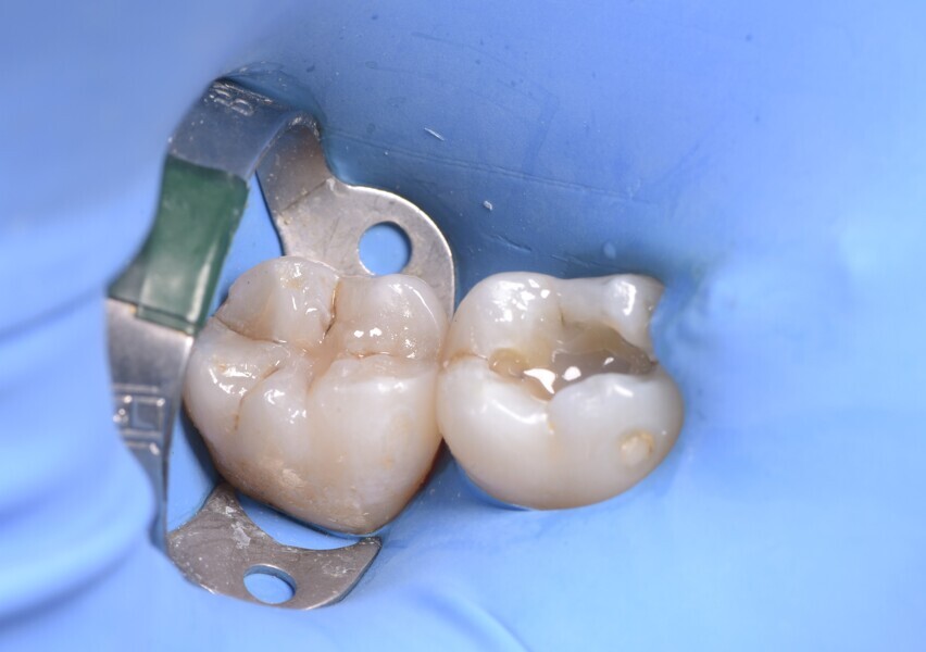 Fig. 5: Second molar already filled, and first molar in need of another layer of flowable composite. 