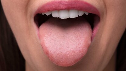 Glossodynie: Ursachen für Zungenbrennen