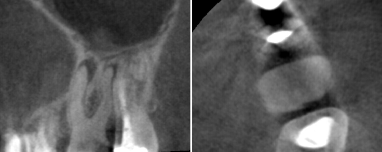 Figs. 48a & b: Pre-op CBCT image confirming calcification of the pulp chamber.