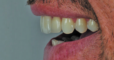 Anterior challenge: obtain high esthetics with two different restoration materials and cements