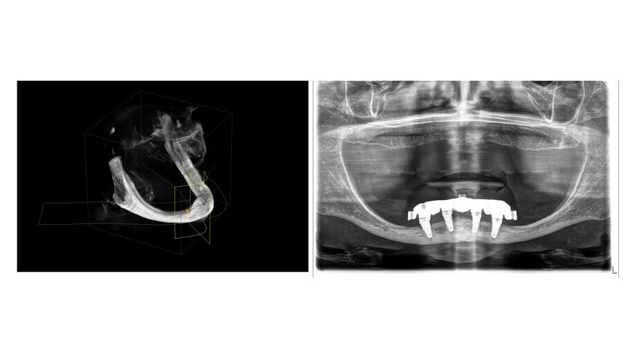 Figs. 10a and 10b : Patient with extremely atrophic bone in the mandible with four short implants placed between the dental nerve foramen