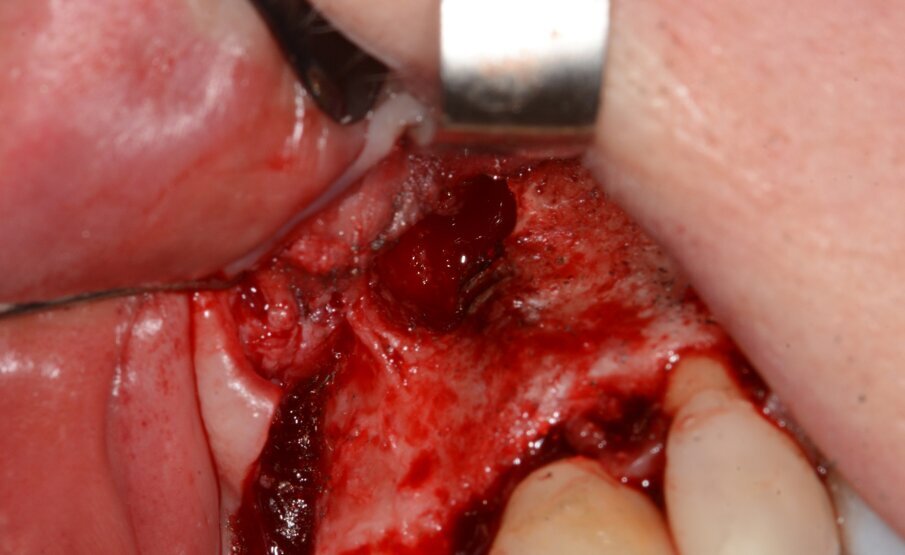 Fig. 17: Implant resection.