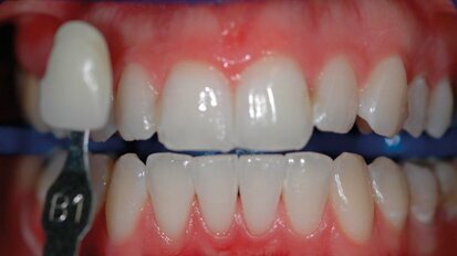 Valutazione clinica degli agenti sbiancanti professionali al 6% e al 25% di perossido di idrogeno su denti vitali