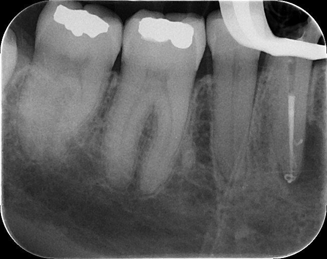 Fig. 8: Intra-op radiograph.