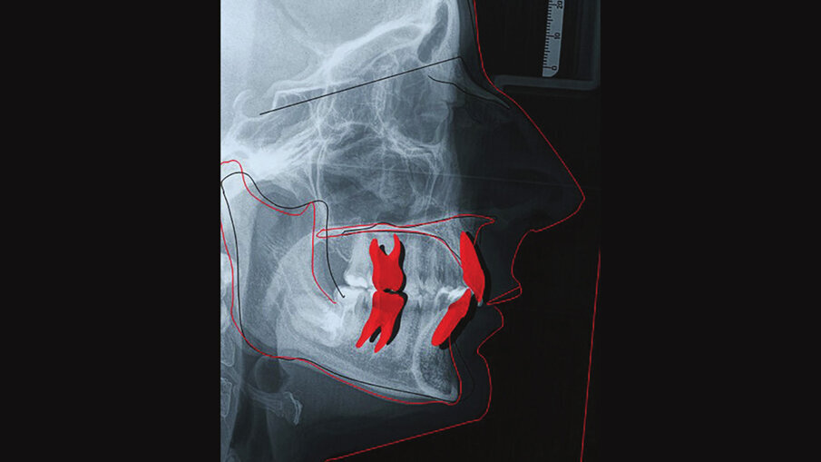 Figg. 9a-9c_Esami radiografici dopo il trattamento, con sovrapposizione sul piano SN. Questo ci mostra come, non potendo proclinare ulteriormente gli incisivi inferiori oltre la sinfisi per sfruttare l’intrusione relativa, l’apertura del morso è stata ottenuta sfruttando al massimo solo movimenti di intrusione assoluta, seppur minimi, e movimenti di intrusione relativa superiore ed estrusione posteriore parziale, considerando la difficoltà di quest’ultima, a causa della tipologia brachifacciale della paziente.