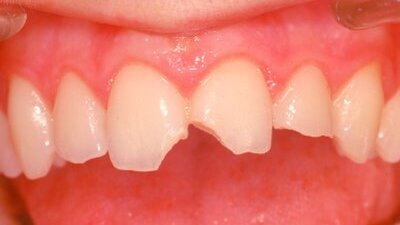 Il punto di vista dell’odontologo forense nella valutazione dei traumi dentali
