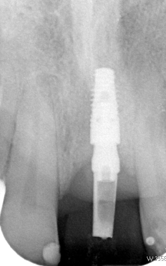 Fig. 6_Rx a 3 mesi con corona provvisoria.