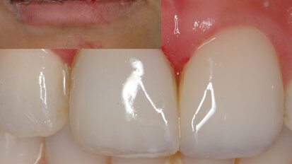 Reconstrucción inmediata de dientes con destrucción avanzada