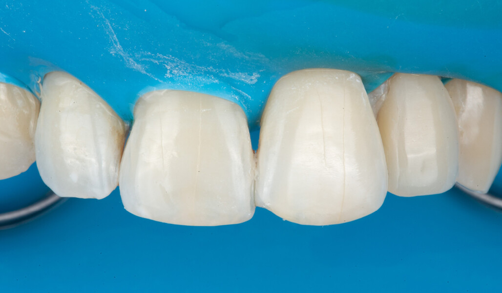 Fig. 8: Frontal view of the maxillary anterior teeth.