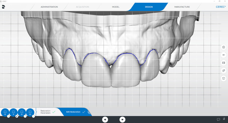 Fig. 7: Export of the data into the CEREC SW 5.1.1 and final design of the veneers.