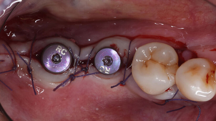 Fig. 10_Foto clinica che mostra la scopertura dei due impianti nel tessuto rigenerato, eseguita nella seduta di rimozione della griglia.