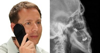 Neurostimulacija: Gingivalni implantat pomaže smanjenju cluster glavobolje