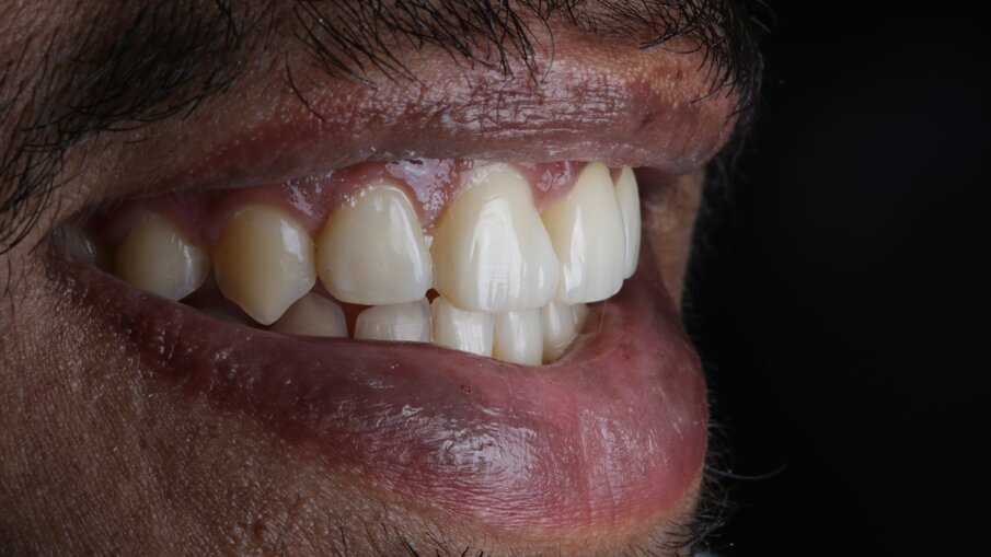 Fig 25: Final Smile