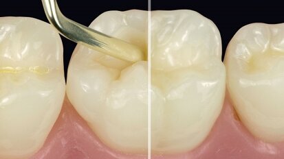Ceram.x universal: excellente adaptatie en modelleerbaarheid