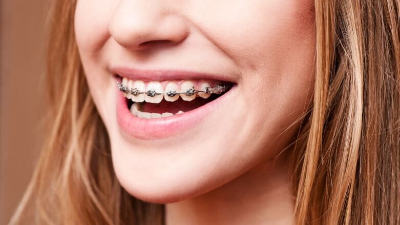 Orthodontische behandeling leidt niet tot meer zelfvertrouwen