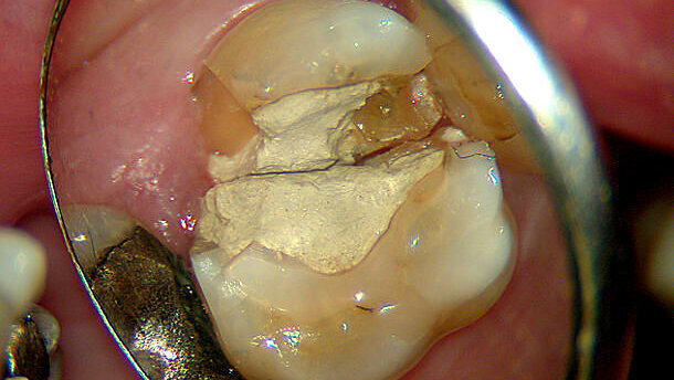 Problemmanagement in der Endodontie