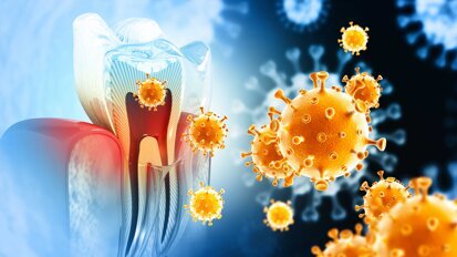DNA-codiertes Nanozym-Sensor-Array gegen Zahnbakterien