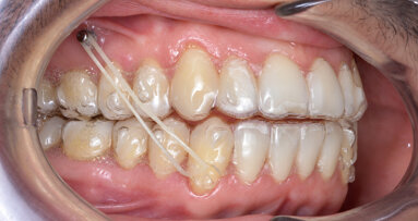Mandibular occlusal plane management with micro-screws to correct an edge-to-edge incisal relationship