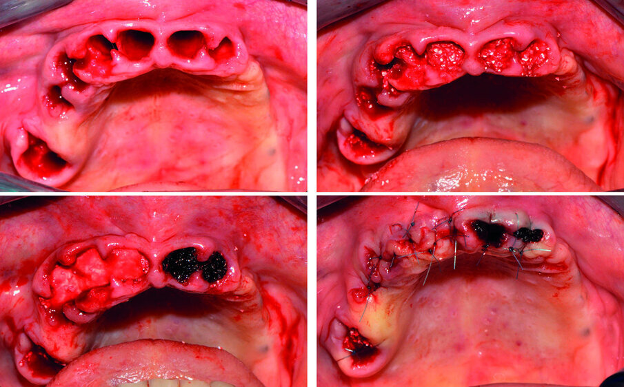 Figg. 3a-3d_(A) dopo l’estrazione degli elementi compromessi, gli alveoli sono stati innestati (b) con il sostituto osseo equino a lento riassorbimento; (c) gli innesti del primo quadrante, ad eccezione di quello in posizione 1.6 sono stati protetti con una membrana in collagene, quelli del secondo quadrante con cellulosa ossidata per poi procedere (d) alla sutura con monofilamento non riassorbibile.