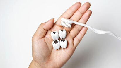 New antibacterial fillings may combat recurring dental caries