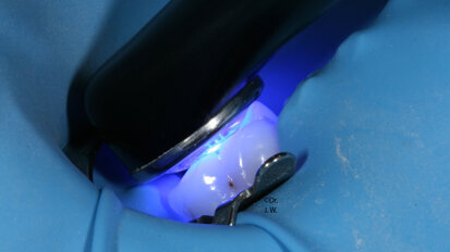 Valo Molar