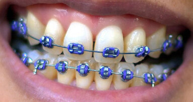 Orthodontieverzekering de moeite waard