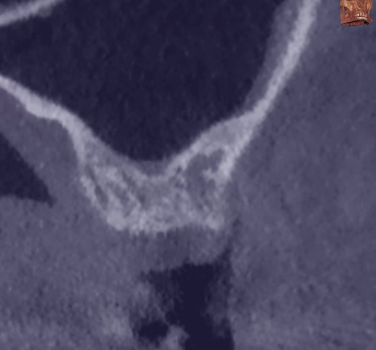 Fig. 1c: Pre-op situation. Sagittal section of the site taken from the CBCT examination.