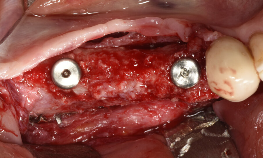 Fig. 9_Foto clinica che mostra l’inserimento di due impianti nel tessuto rigenerato a distanza di 7 mesi dalla ricostruzione ossea. 