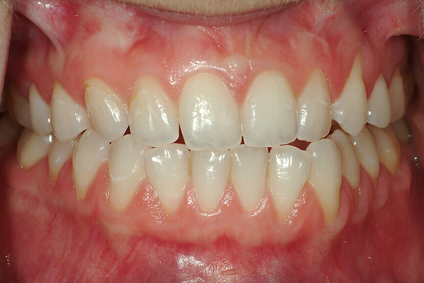 Fig. 16: Occlusion with intercuspation but a non-functional
mandibular position.