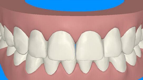 Smile Makeover: Ortodonzia preprotesica finalizzata alla Cosmesi odontoiatrica