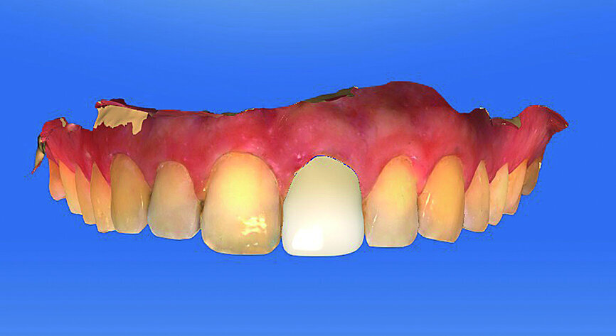 Fig. 5: The prosthetic proposal was also used as the basic file for producing the surgical guide with the gap at position #21.