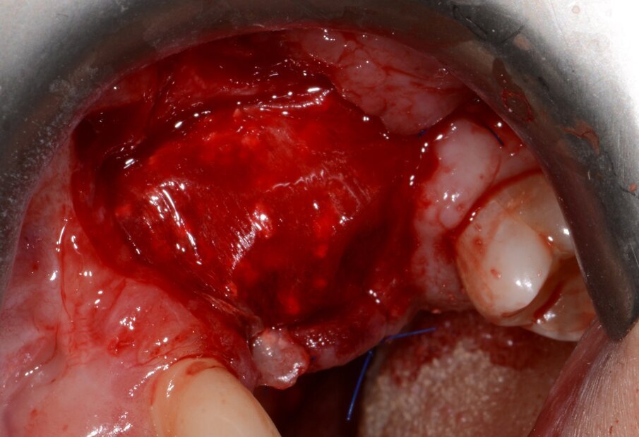 Fig. 11: Bone augmentation