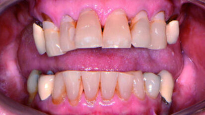 Using CAD/CAM for a combination approach to full mouth reconstruction