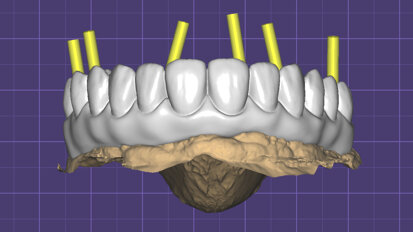 Efficient production of a hybrid implant-supported full-arch prosthesis