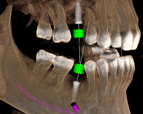 Neoss Digital Workflow with Dentsply Sirona