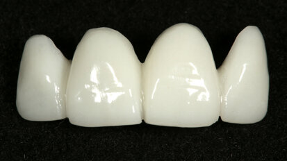 Integrating digital smile design into the analogue aesthetic workflow