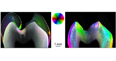 Mit Nanoforschung der Karies auf der Spur