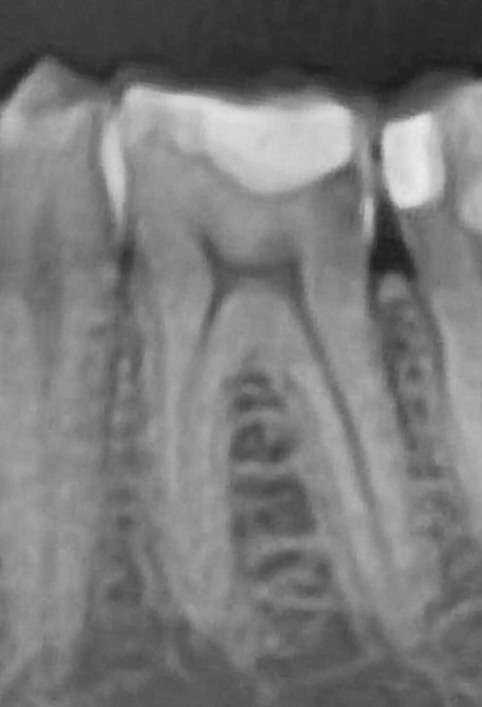 Fig. 2: Panoramic radiograph showing a distal carious lesion.
