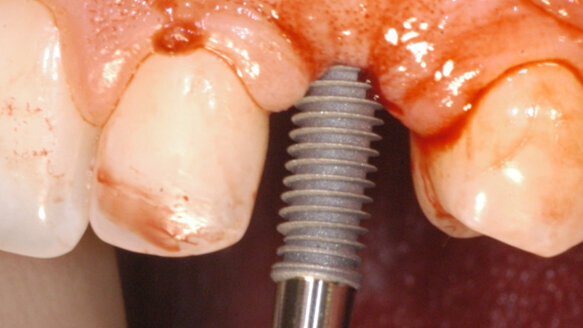 KAT Implants: Key Assisted Transfer system