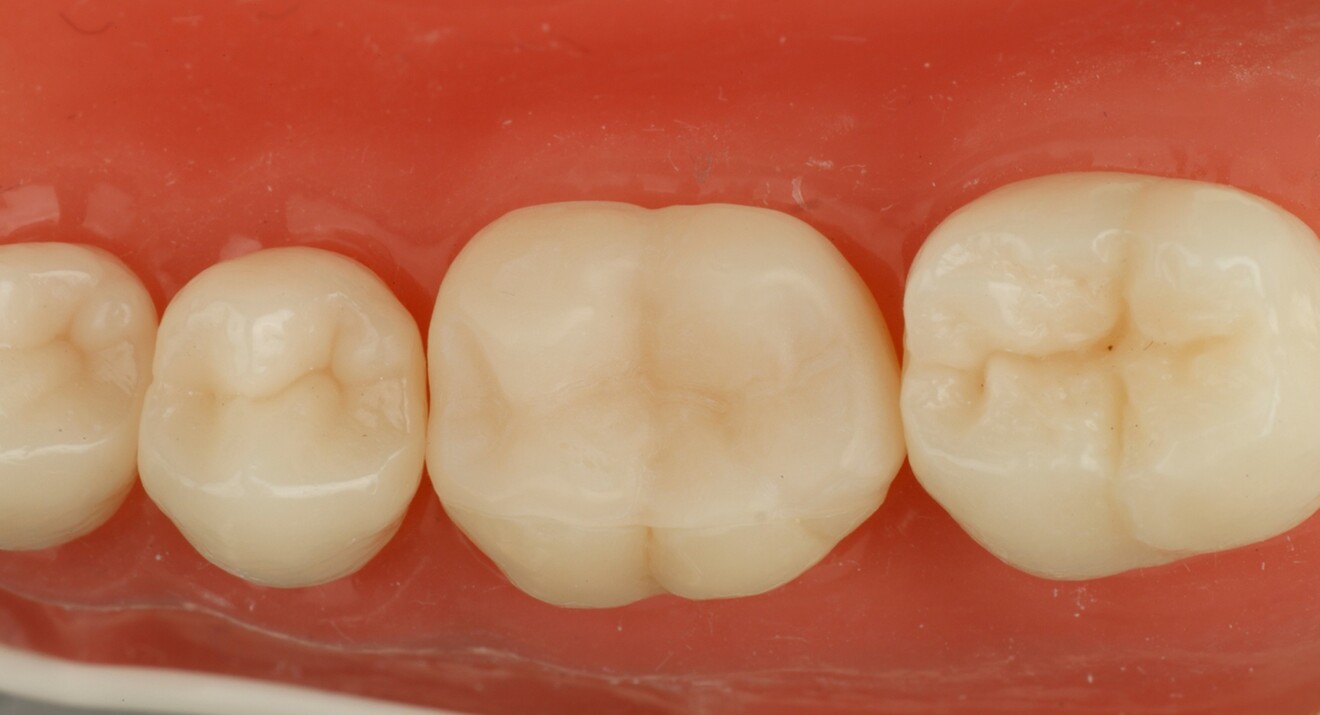 Fig. 2c: Try-in.