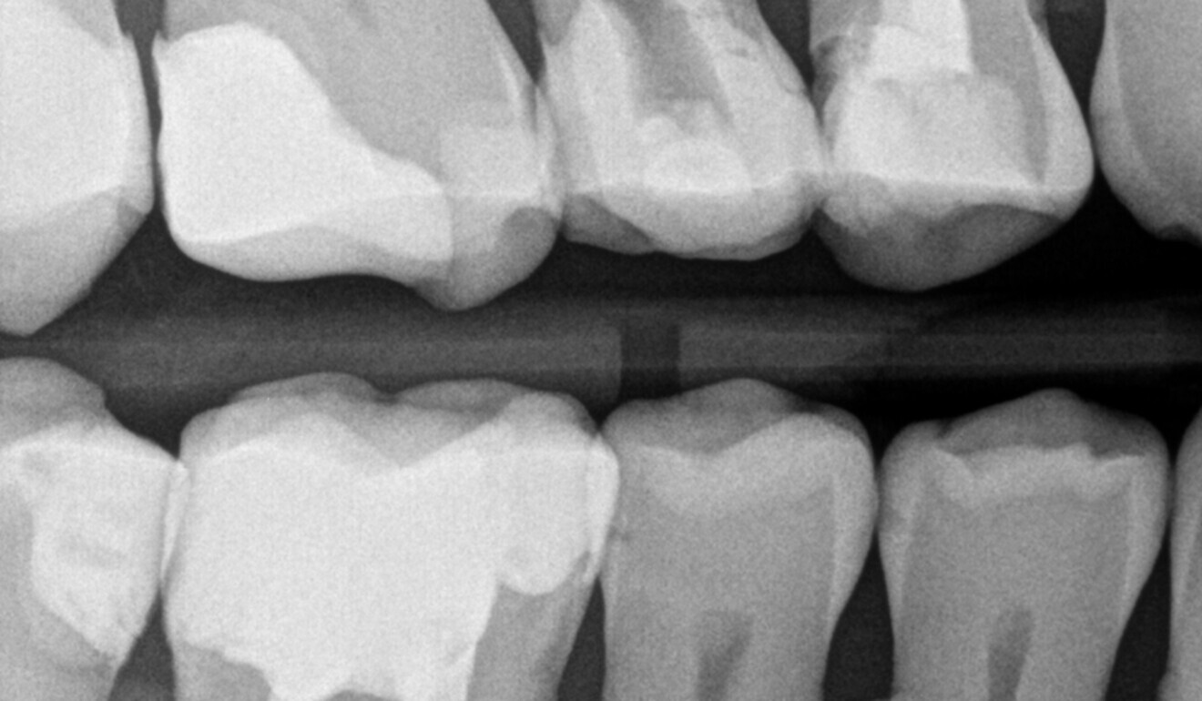 Fig. 3: Bitewing radiograph. Maxillary first molar with an overhang and negative profile of the distal wall. (Image: Kuraray Noritake Dental)