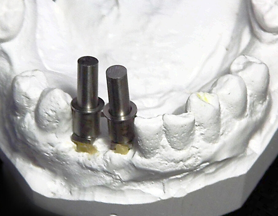 Fig. 9: Guide sleeves were placed on the upper removable parts of the corrected guide posts.