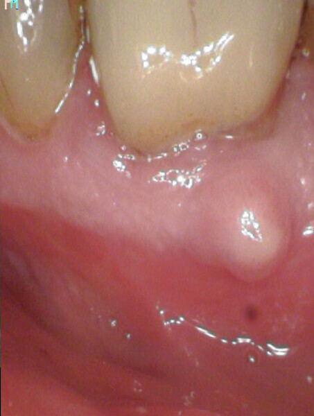 Fig. 8b: Pre-op radiograph showing the fistula facing the coronal part of the root canal.