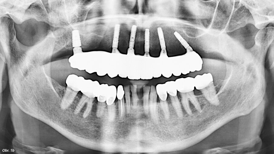 Použitím tilted implantátů využijeme stávající kost bez nutnosti augmentace.